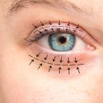 La cirugía estética de ojos, la que más viene creciendo en España