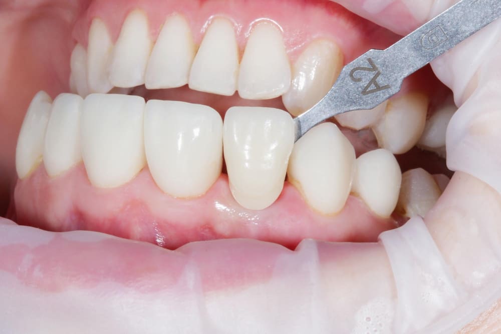 Carillas dentales: una sonrisa radiante al alcance de tu mano